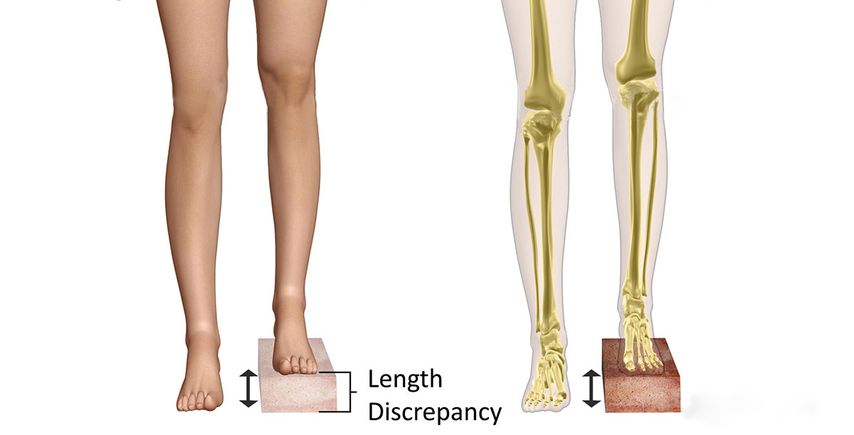 discrepancia de longitud de las piernas